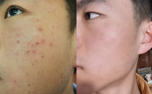 白瓷娃娃每次治疗间隔多久？