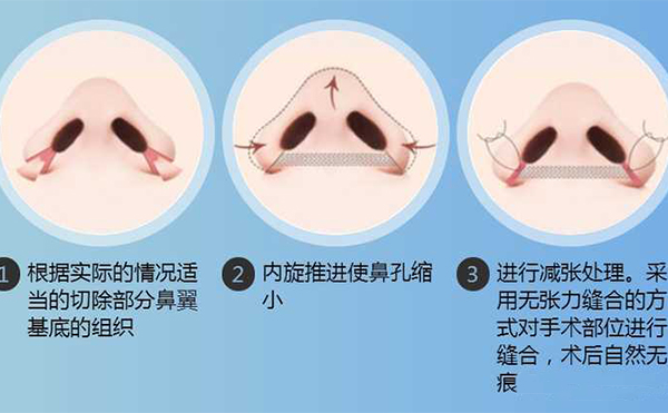 鼻翼缩小手术有用吗？