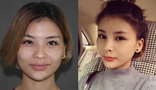 北京禾美嘉面部填充打造精致少女脸