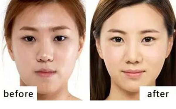 自体脂肪丰卧蚕有什么优势?能维持多久?