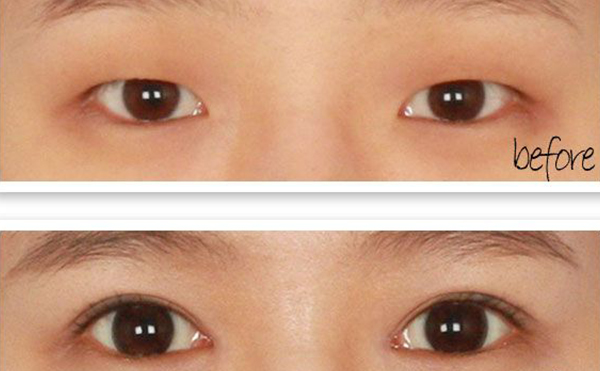 单眼皮可以只开眼角吗?效果怎么样?