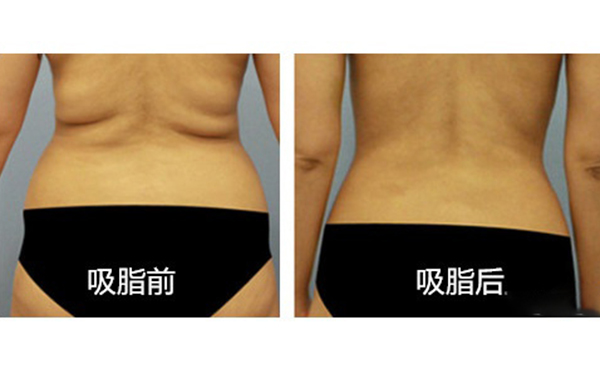 腹部吸脂需要多久恢复？