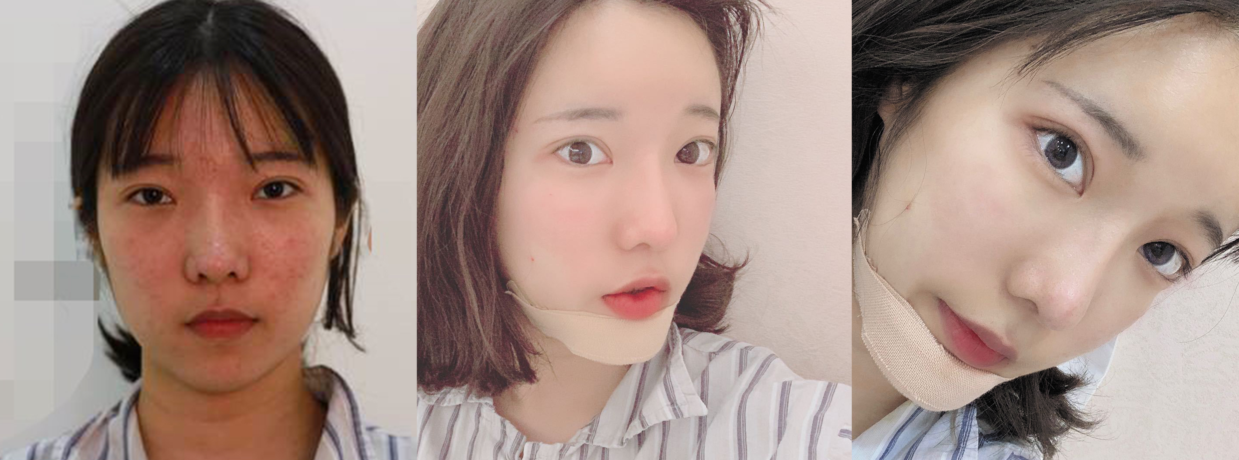 杭州时光自体脂肪填充效果图1