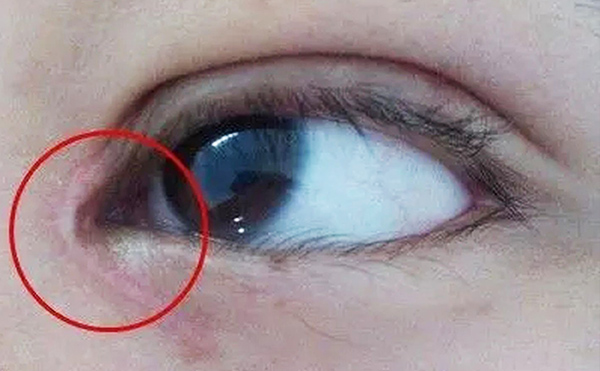 内眼角修复难不难？哪些情况需要修复?