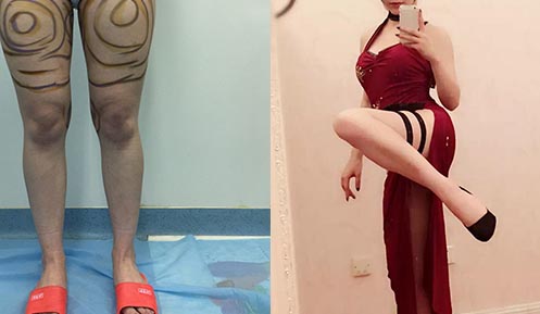 大腿吸脂前后效果对比图