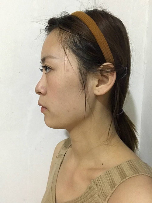 天津伊美尔超肋鼻综合案例大赏