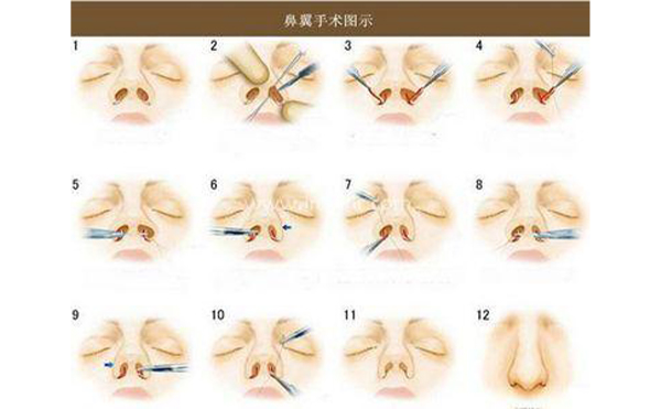 南昌爱思特做鼻翼缩小怎么样?时间久了会不会反弹