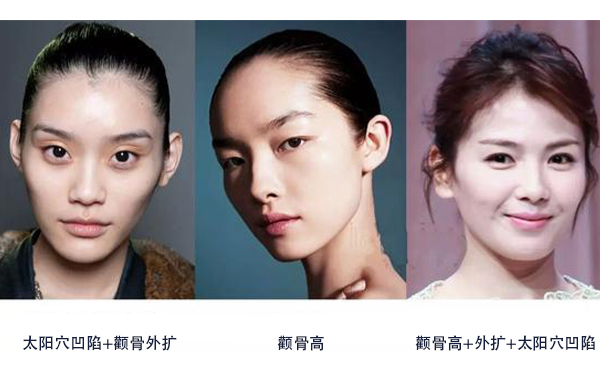 怎么区分是颧骨高还是太阳穴凹陷？