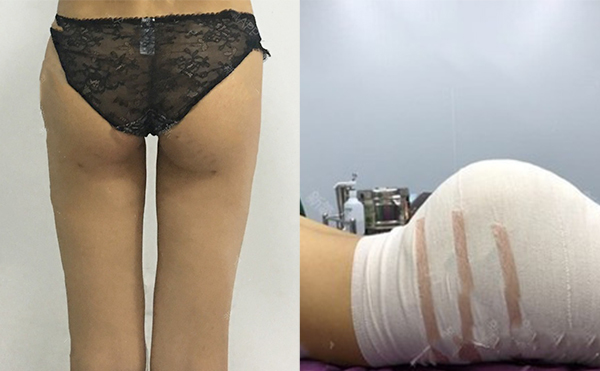 做假体丰臀有没有年龄限制?哪些人不适合做假体丰臀?