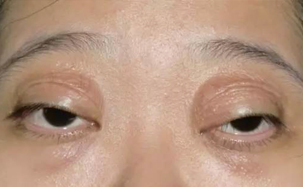 如何区分肿泡眼和眼球突出?术前检查过程?