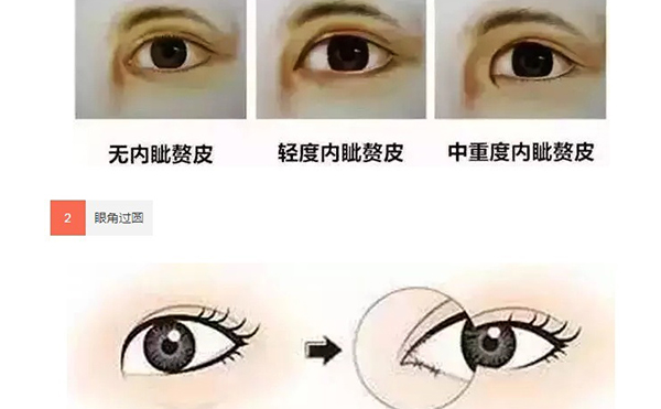 单眼皮可以只开眼角吗?效果怎么样?