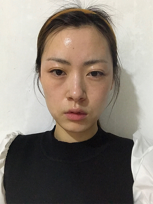 天津伊美尔超肋鼻综合案例大赏