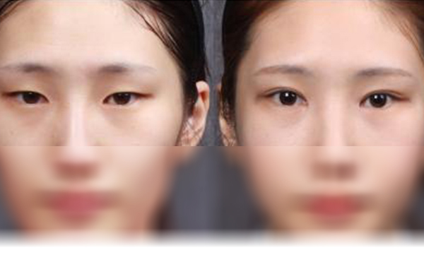 双眼皮和开眼角可以一起做吗?效果怎么样?