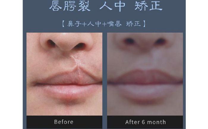 唇裂修复术需要多少钱？