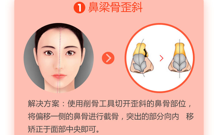歪鼻矫正