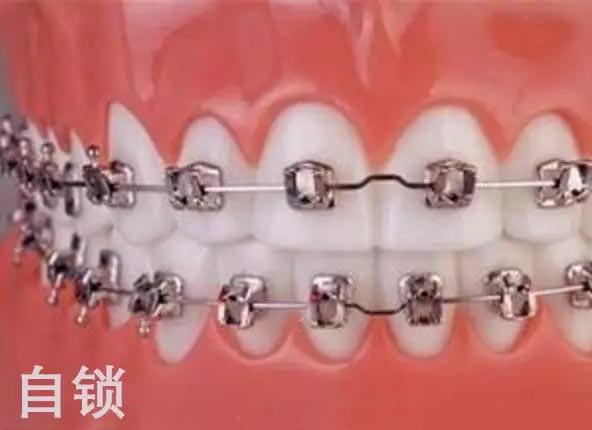自锁牙套