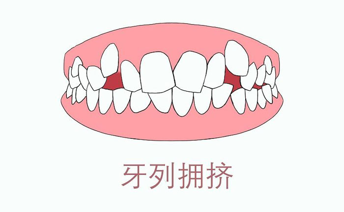 矫正牙齿拥挤度怎么算？