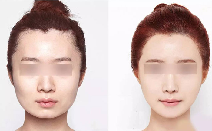 脸部咬肌肥大怎么瘦？脸部咬肌肥大如何去除？