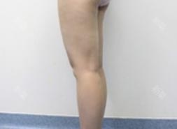 太原时光整形王国军大腿吸脂案例