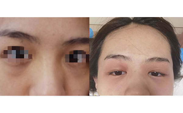 光子嫩肤去黑眼圈怎么样？