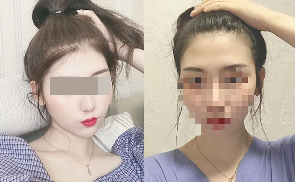冰点脱毛后多久可以洗澡吗？