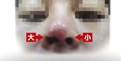 隆鼻手术