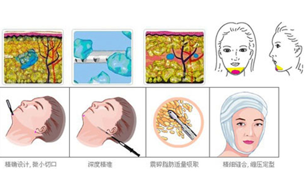 下巴整形吸脂术要多少钱？