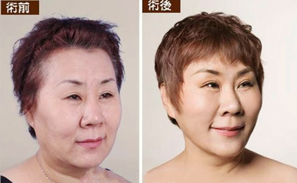 拉皮手术多久能恢复自然？