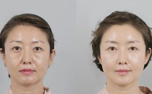 拉皮手术的过程是什么?术后需要注意什么?