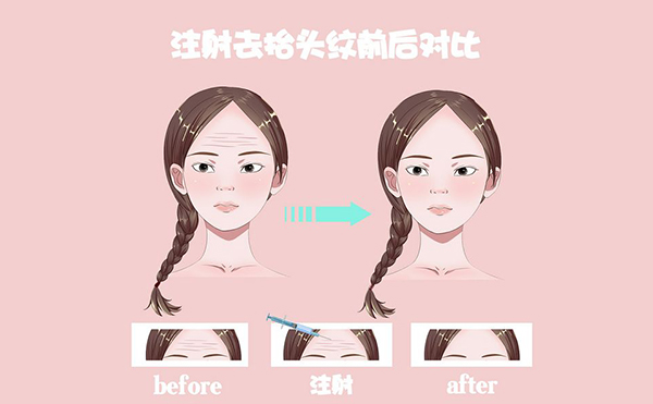 电波拉皮怎么去除抬头纹？
