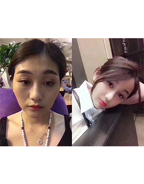 东方纳米脂肪移植