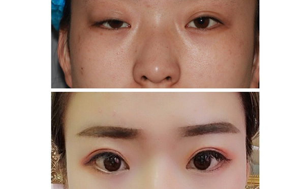 大小眼矫正多少钱?术后效果好不好?