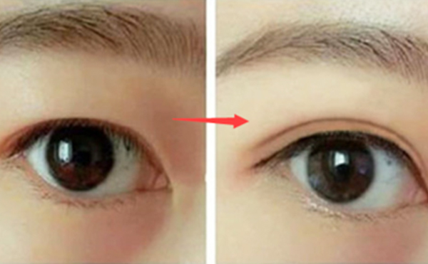眼球突出可以做双眼皮吗?效果怎么样?