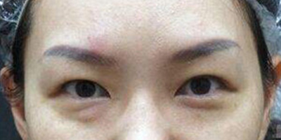 激光祛眼袋术前