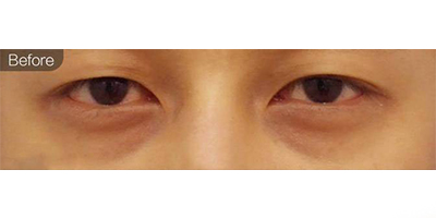胶原蛋白去黑眼圈术前