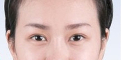 上眼睑去脂术后