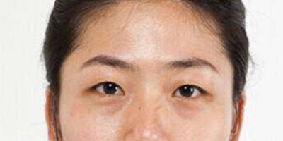 光纤溶脂祛眼袋术前