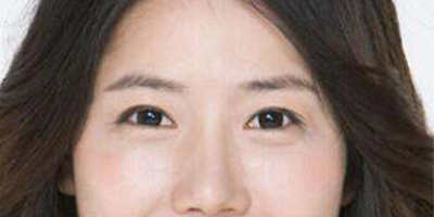 光纤溶脂祛眼袋术后