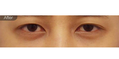 胶原蛋白去黑眼圈术后