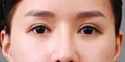自体脂肪丰卧蚕术前