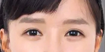 自体脂肪丰卧蚕术后