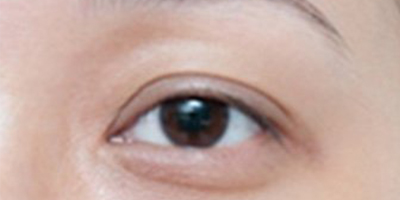 玻尿酸丰眼窝术前