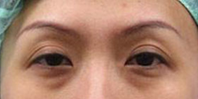 玻尿酸去黑眼圈术前