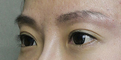 玻尿酸丰眉弓术后