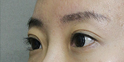 玻尿酸丰眉弓术前