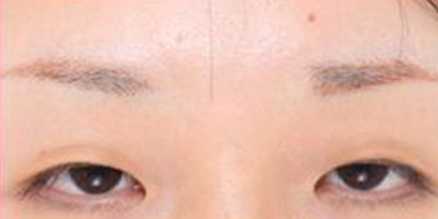 假体垫眉弓术前