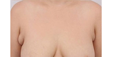 吸脂去副乳术前
