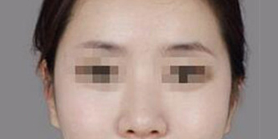 颧骨内推术后