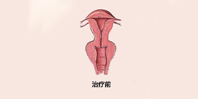 手术紧缩阴道术前