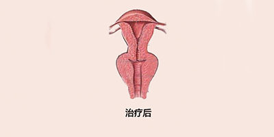 手术紧缩阴道术后